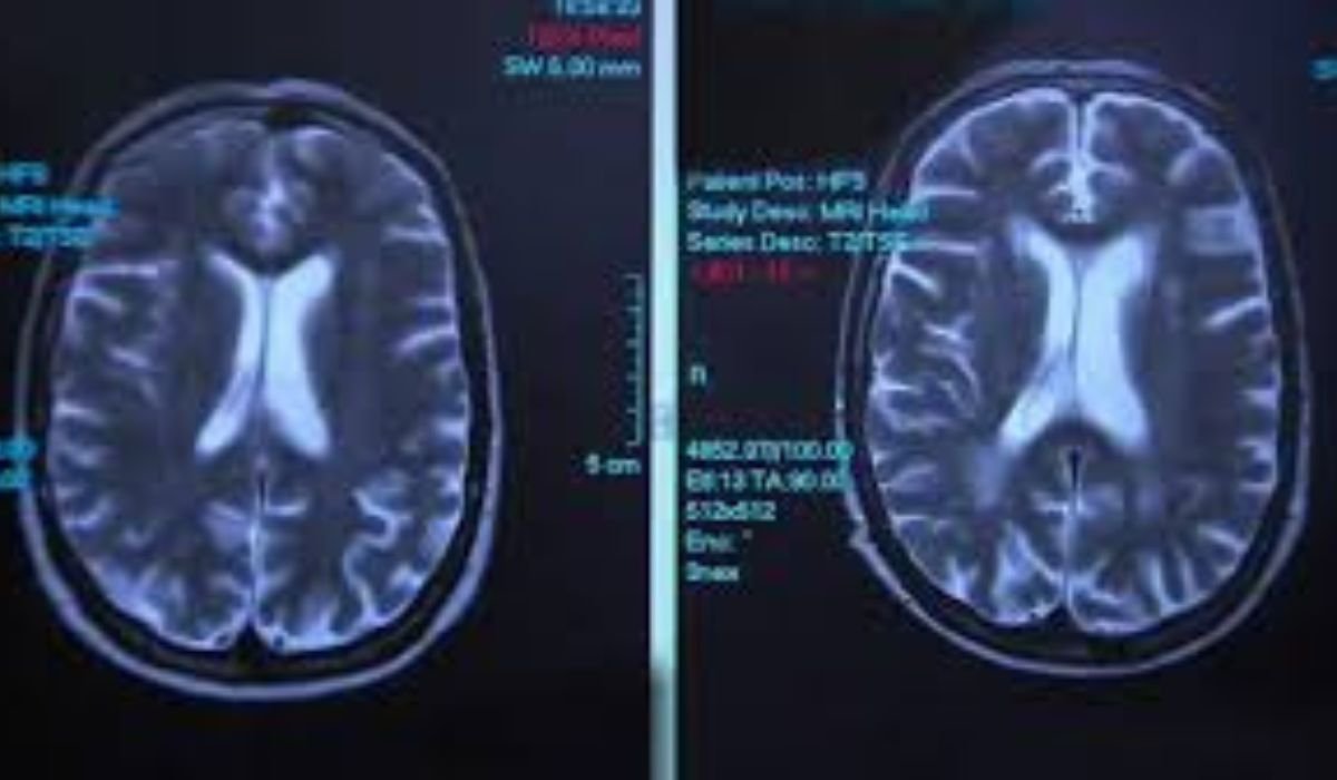Impact of Alcohol: MRI Can Reveal the Brain Damage and Dementia
