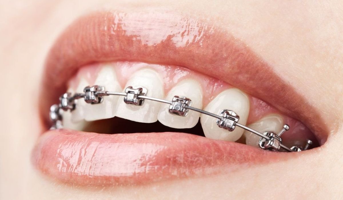 The Benefits of Getting Braces (Even If They Hurt)