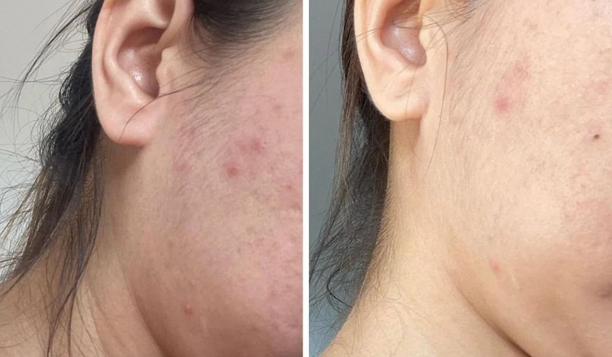 Your skin type requires an appropriate remedy for pimple treatment