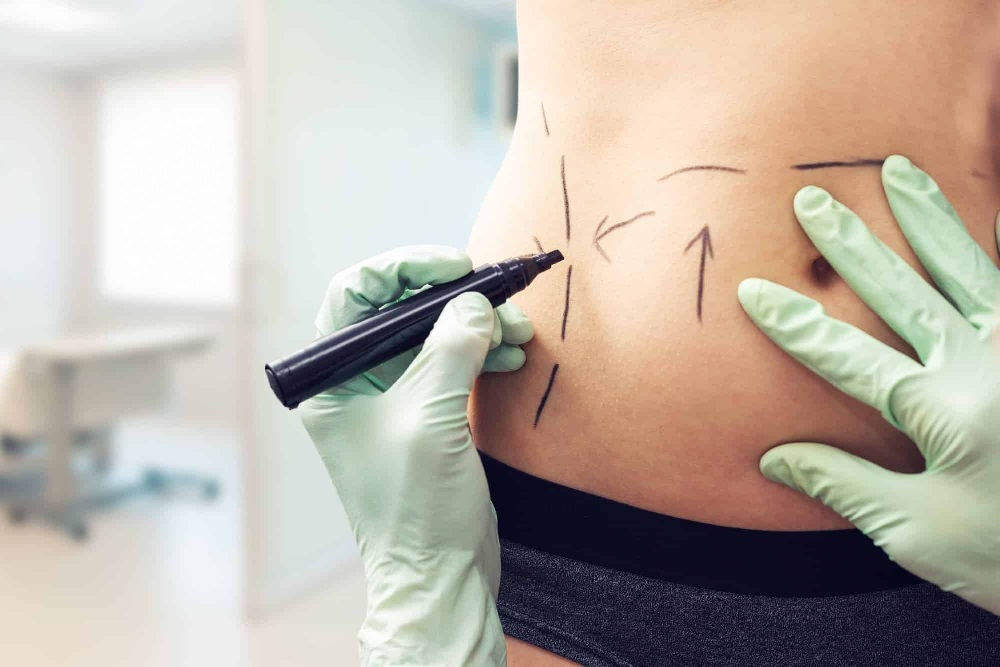 How Professional Plastic Surgeons in Sydney Ensure Successful Outcomes in Neck Lipoplasty Procedures
