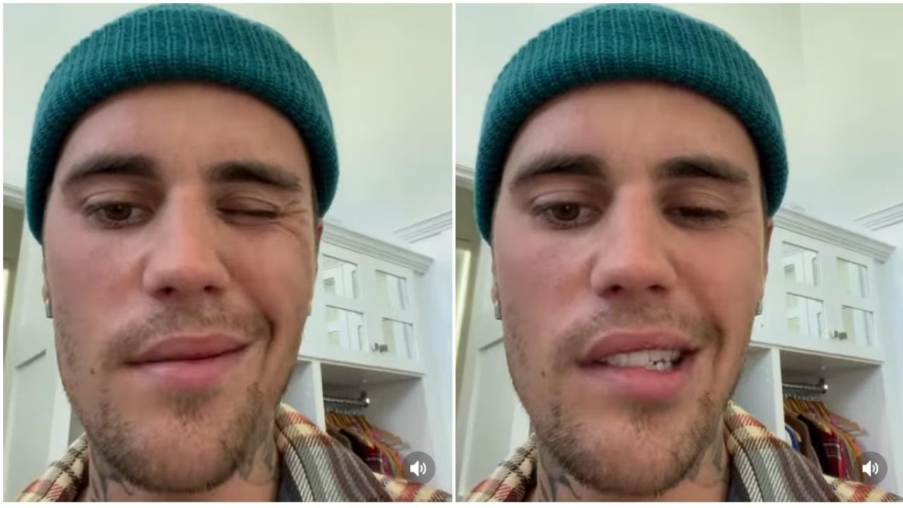Justin Bieber Paralyzed: Opens Up About Facial Paralysis Following Show Cancellations