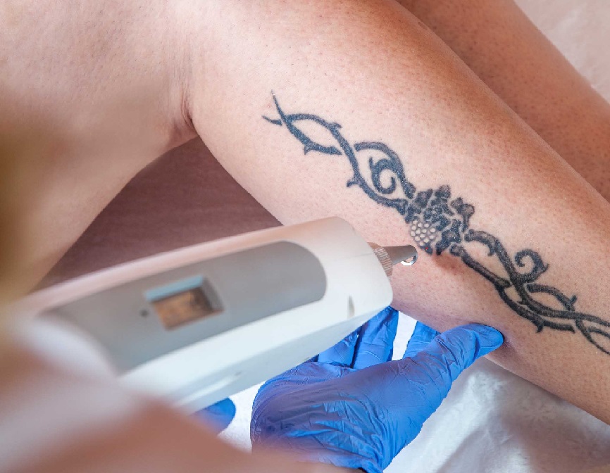 Why Is Laser Tattoo Removal Considered the Most Effective Method in Vancouver?