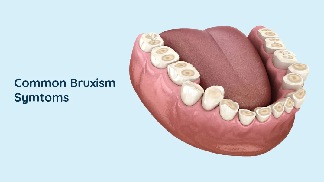 Bruxism