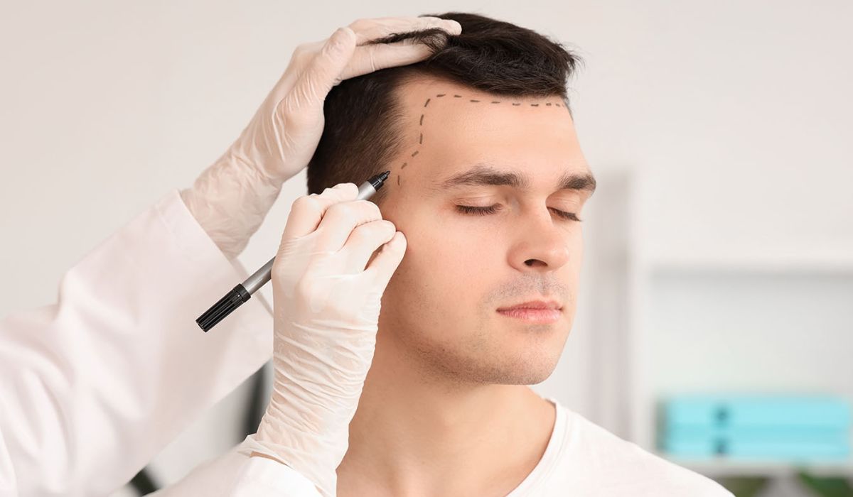 Hair Transplant in Switzerland: Precision, Innovation, and Natural Results