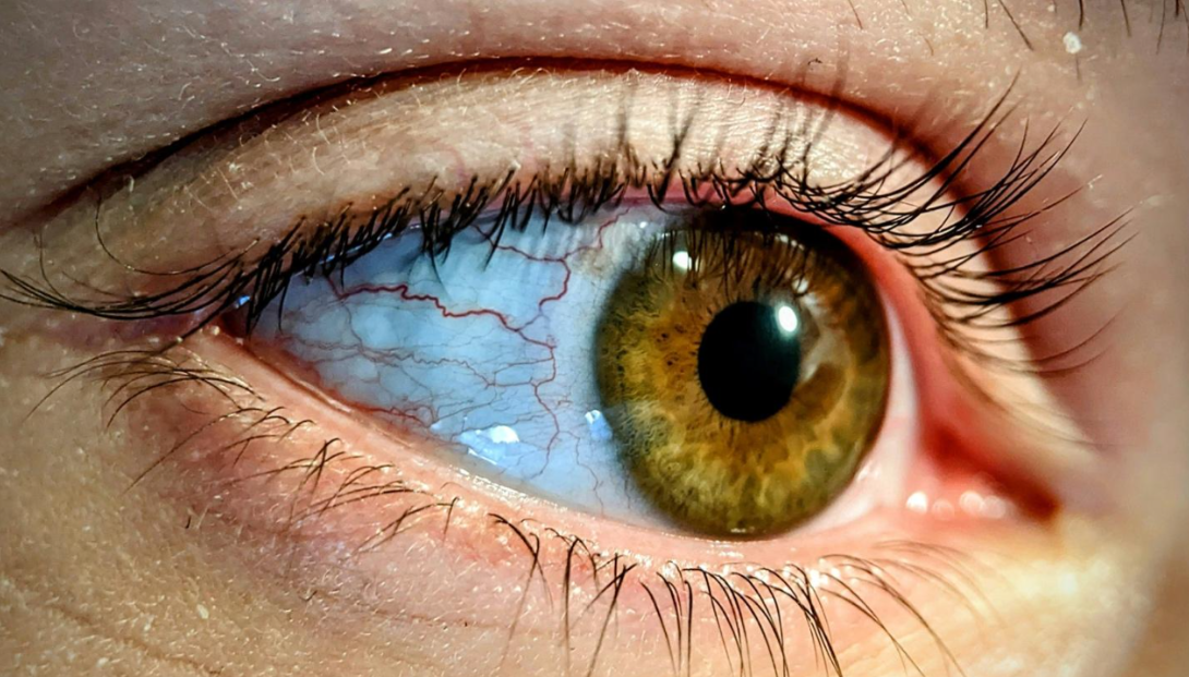 A New Vision Standard: Understanding EVO Eye Surgery